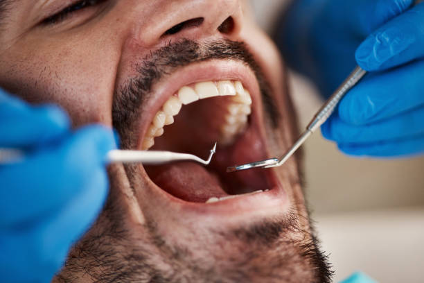 Best Emergency Wisdom Teeth Removal in Monticello, IN
