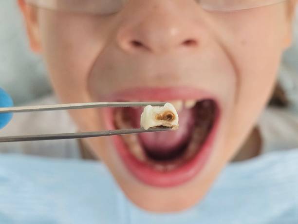 Best Emergency Tooth Extraction in Monticello, IN